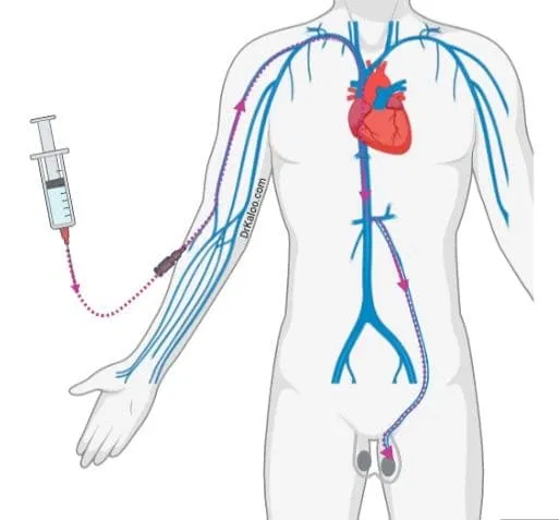قسطرة دوالي الخصية: هل لها عيوب وأضرار؟ 3 نصائح بعد قسطرة دوالي الخصية