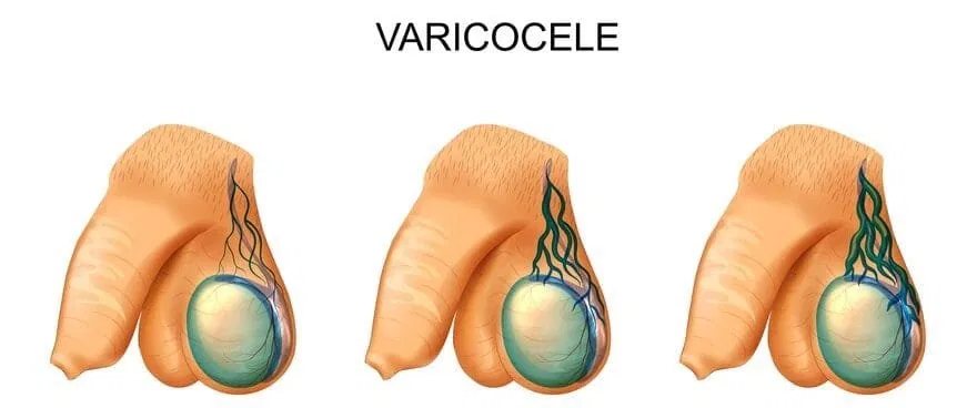 درجات دوالي الخصية بالصور