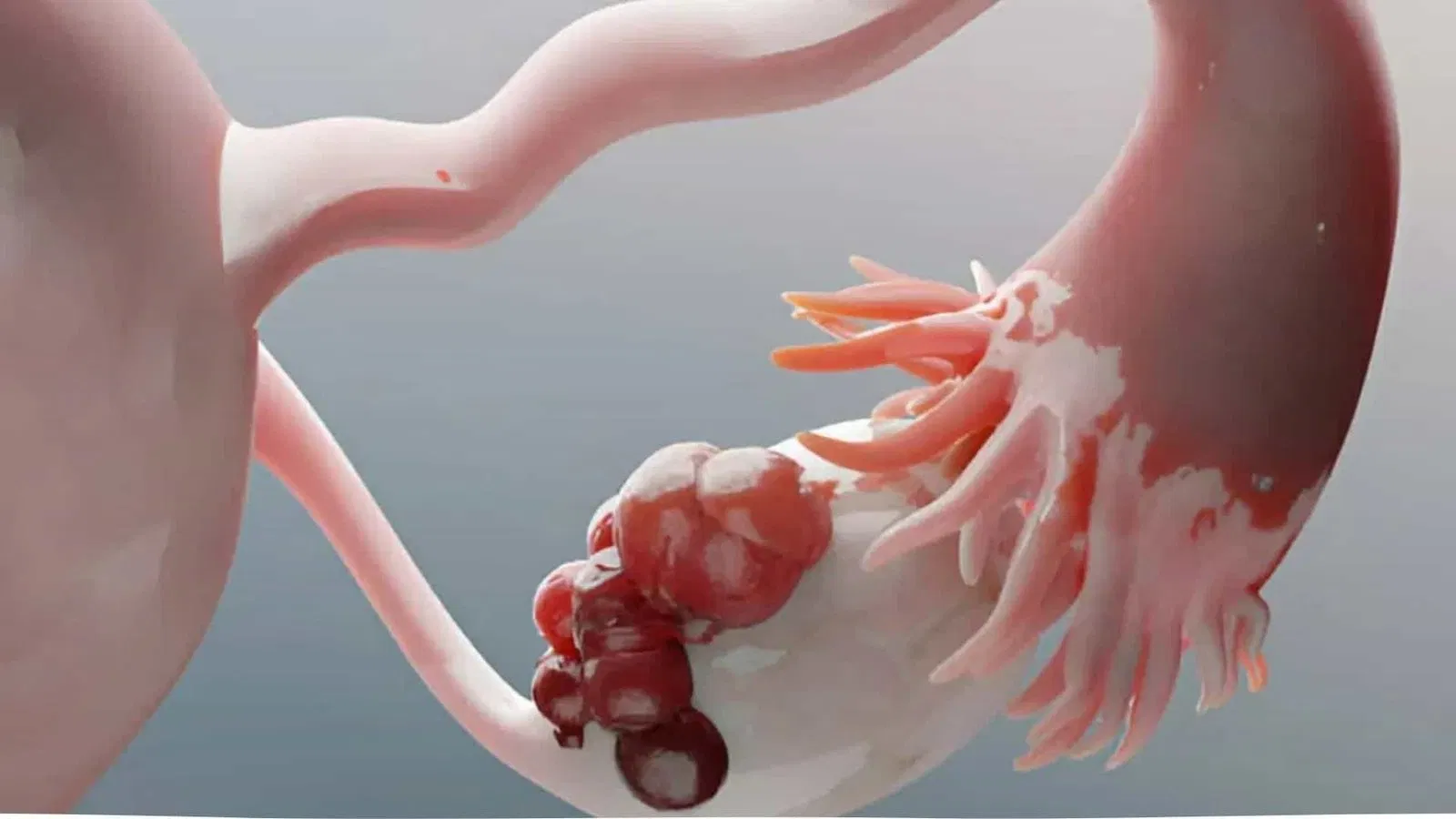 كيس على المبيض حجمه 5 سم