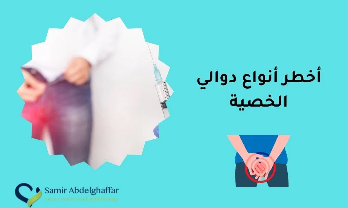 أخطر أنواع دوالي الخصية
