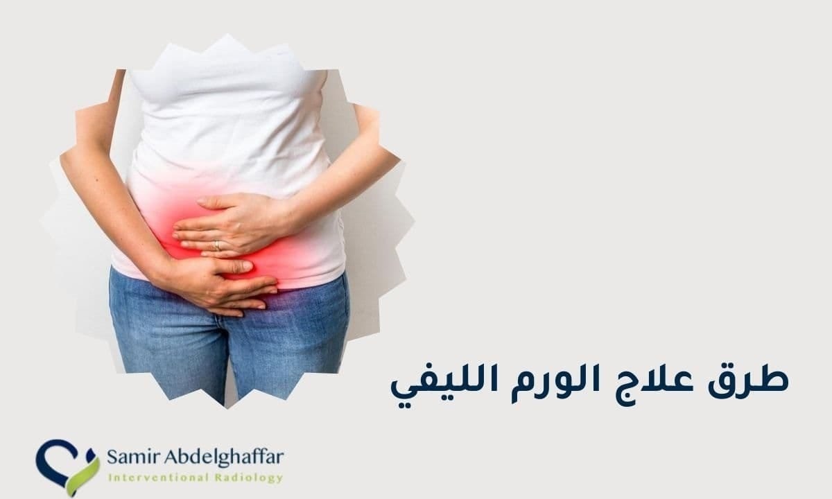 تجربتي مع الورم الليفي والحمل - تأثير تليف الرحم على الولادة 1 طرق علاج الورم الليفي