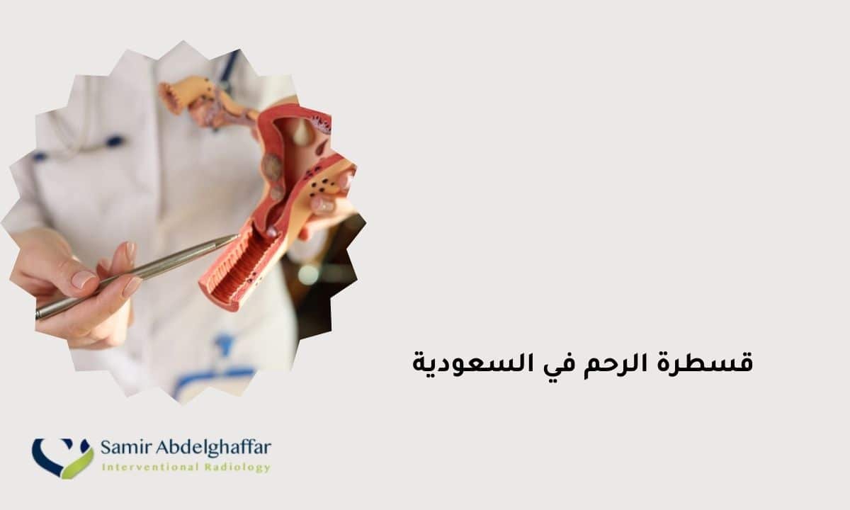 قسطرة الرحم في السعودية: أفضل علاج لتليف الرحم والعضال الغدي 1 قسطرة الرحم في السعودية