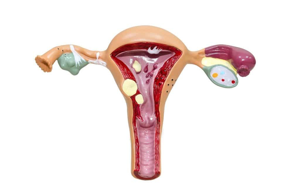 الرحم الغدي (Adenomyosis): الأعراض والعلاج مع د. سمير عبد الغفار 1 الرحم الغدي