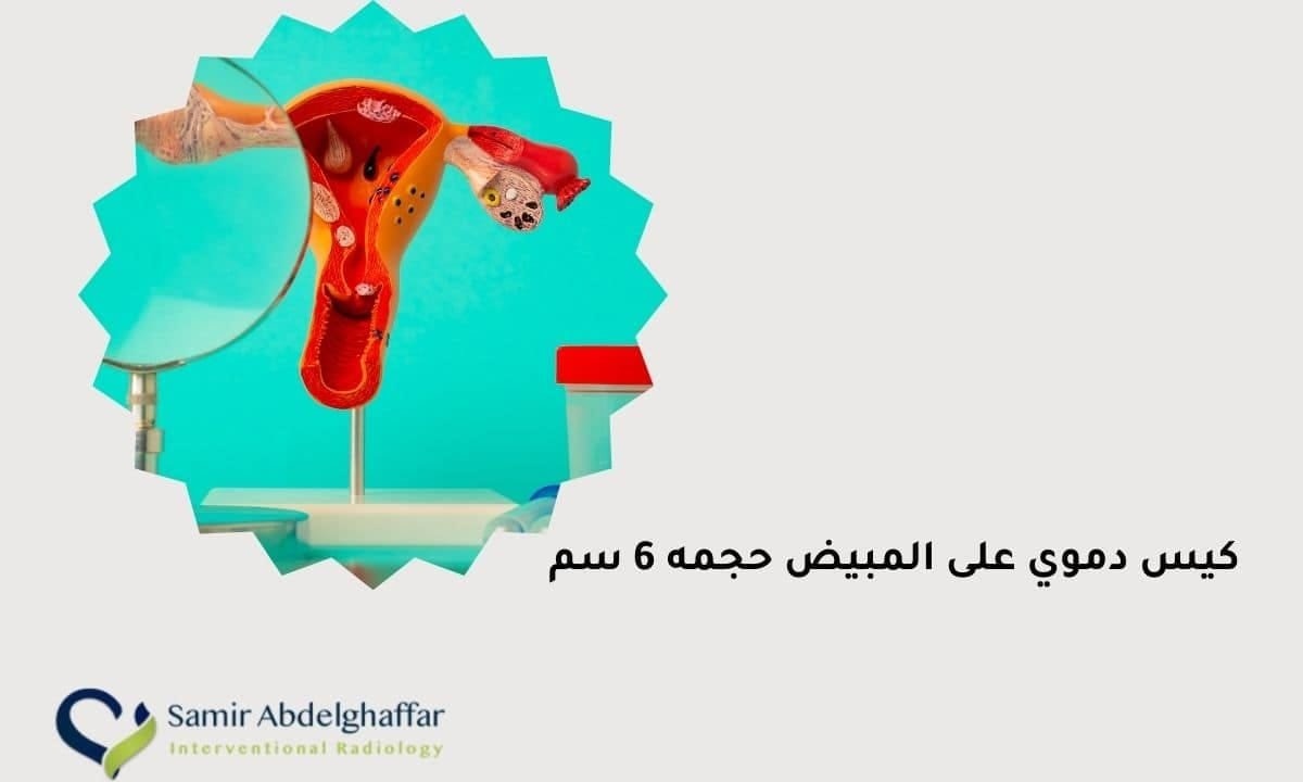 6 Cm Ovarian Cyst