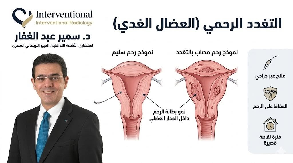 علاج التغدد الرحمي بدون استئصال الرحم 1 علاج التغدد الرحمي العضال الغدي بدون جراحة مع د. سمير عبد الغفار