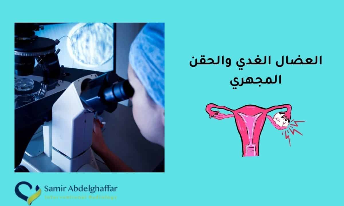 العضال الغدي والحقن المجهري | علاج لتأخر الإنجاب 1 العضال الغدي والحقن المجهري