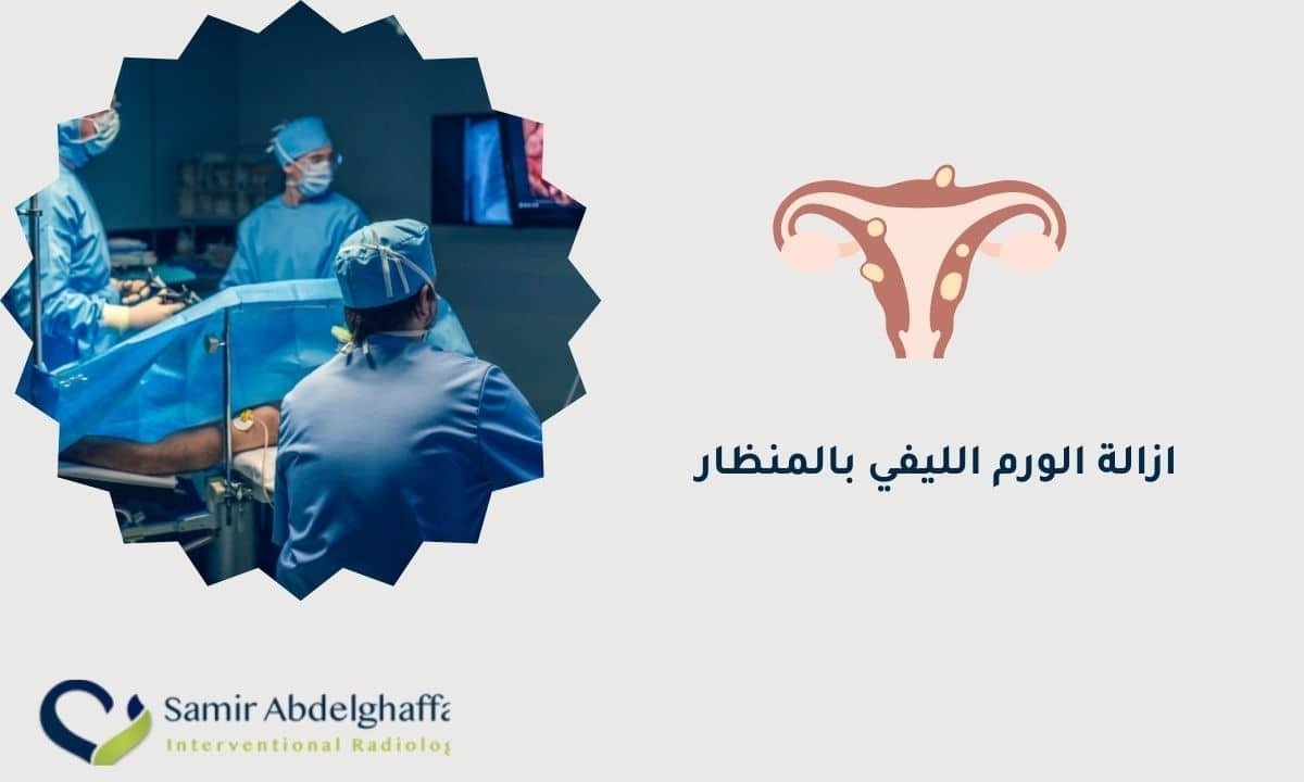ازالة الورم الليفي بالمنظار