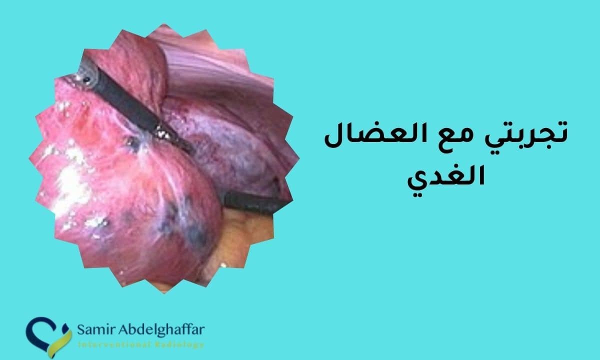 تجربتي مع العضال الغدي: قصة شفائي من الألم والنزيف! 1 تجربتي مع العضال الغدي