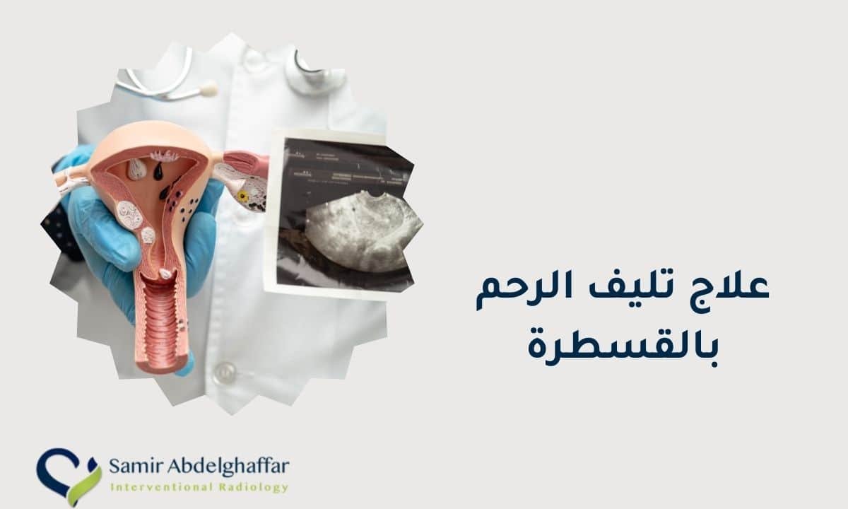 علاج تليف الرحم بالقسطرة | افضل علاج مجرب للورم الليفي 1 علاج تليف الرحم بالقسطرة