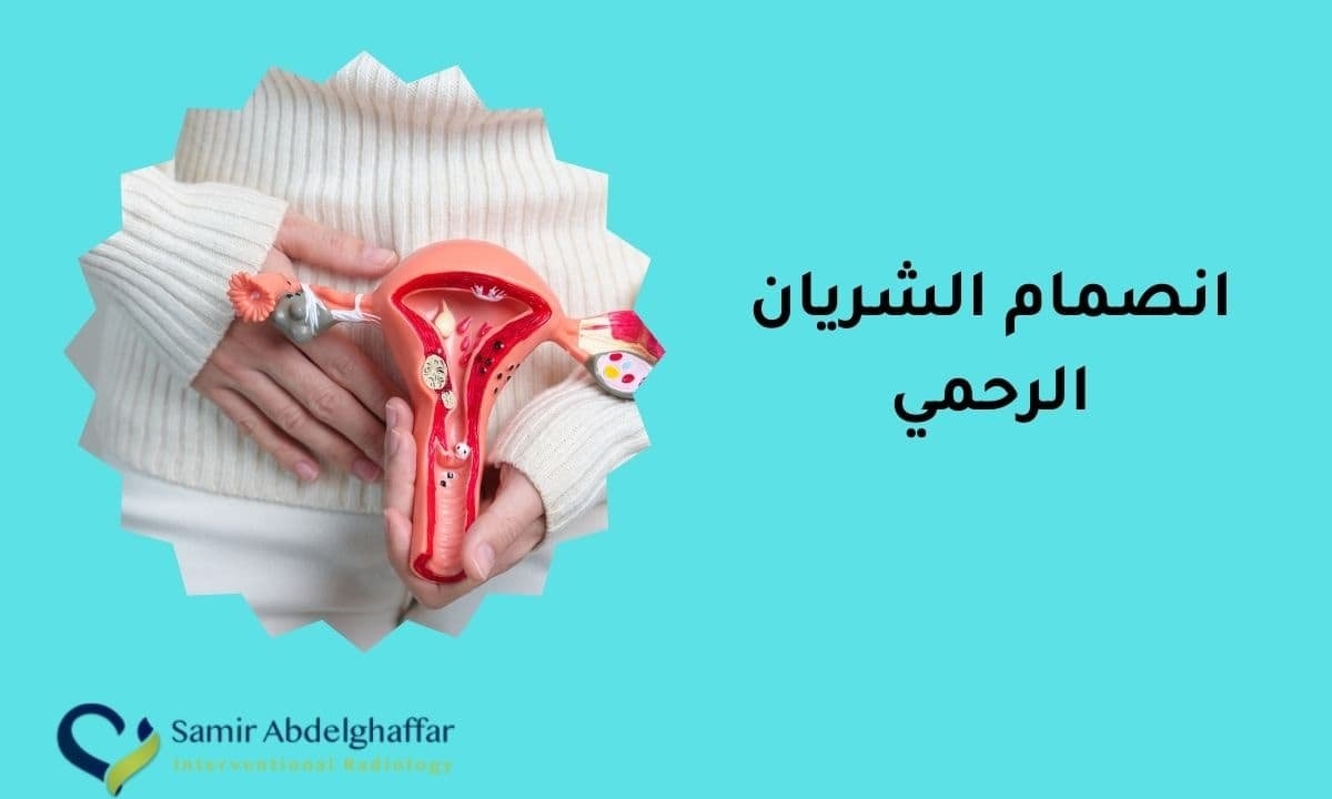 انصمام الشريان الرحمي